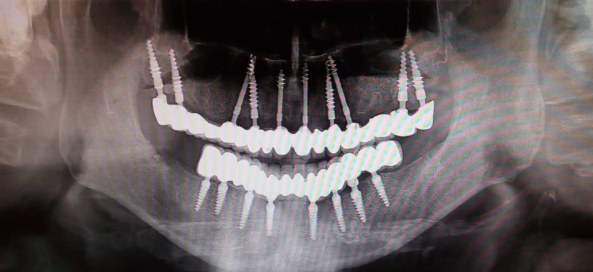 Immediate loading Full Mouth dental implants